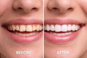 Before and after results of porcelain dental veneers.